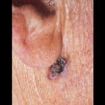 Basal Cell Carcinoma specialist