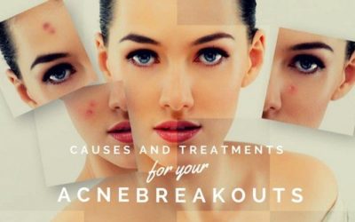 Causes and Treatments for Your Acne Breakouts