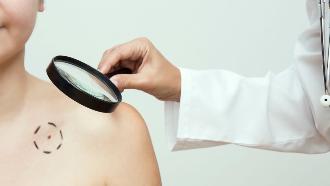 checking for signs of skin cancer