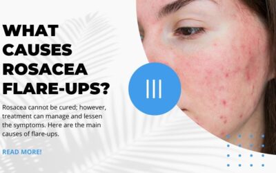 Main Causes of Rosacea Flare-Ups