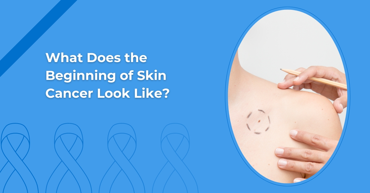 What does the beginning of skin cancer look like?