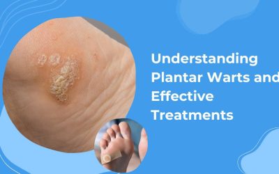 Are Plantar Warts Contagious